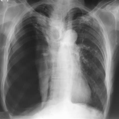 PDF Reexpansion Pulmonary Edema After Drainage Of Pneumothorax