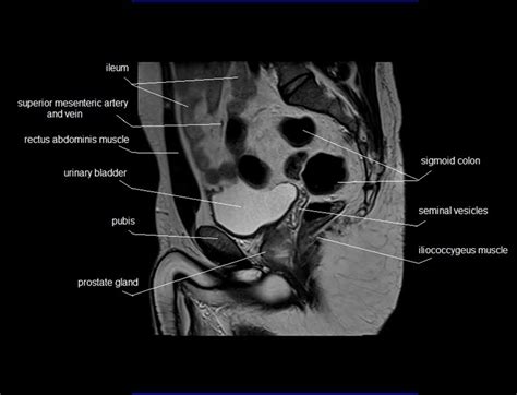 Sagittal Male Pelvis