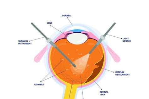 Clearing The Haze 2024s Guide To Vitrectomy For Floaters Eye