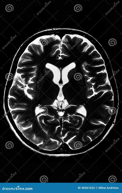 Horizontal Section of a Human Brain Stock Photo - Image of healthcare ...