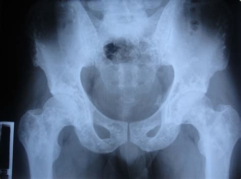 Spotted Bone - A Spot Diagnosis | British Journal of Medical Practitioners