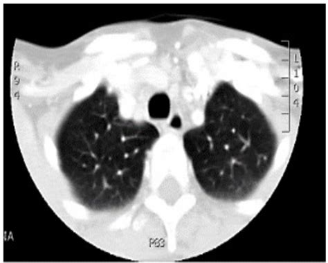 Sarcoma De Kaposi En Orofaringe En Paciente Postrasplante Renal Y