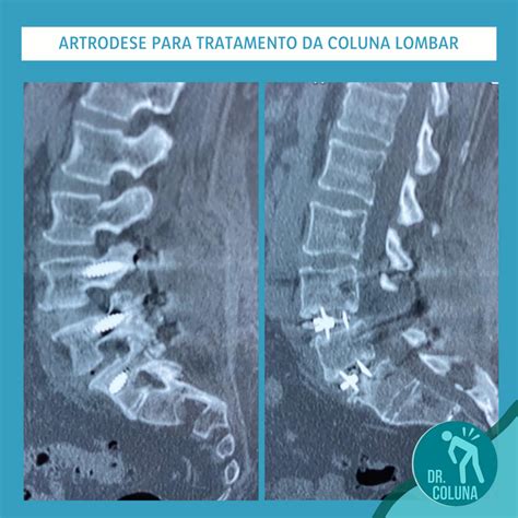 Caso Cl Nico Artrodese Para Tratamento Da Coluna Lombar