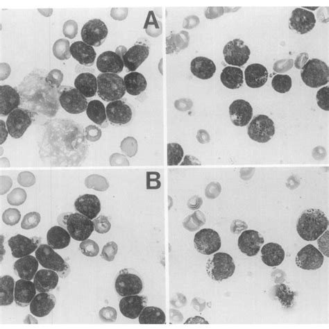 Bone Marrow Two Cases Of Acute Lymphoblastic Leukemia With Numerous Download Scientific