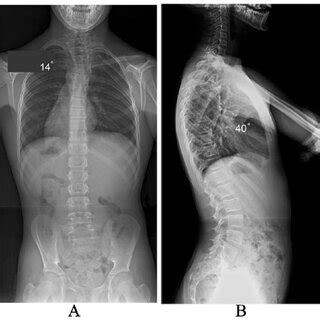 A Postero Anterior And B Lateral Radiographs At Age 22 3 Years Show