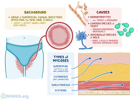 Cutaneous Mycoses What Are They Causes Treatment And More