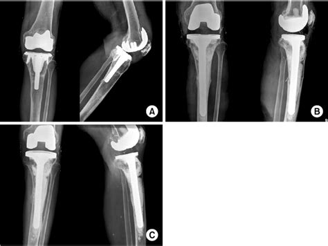 A Anteroposterior And Lateral Radiographs Show A Type Iib Download Scientific Diagram