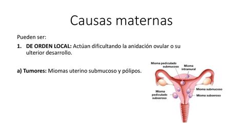 Aborto Causas Maternas Joelconh Udocz