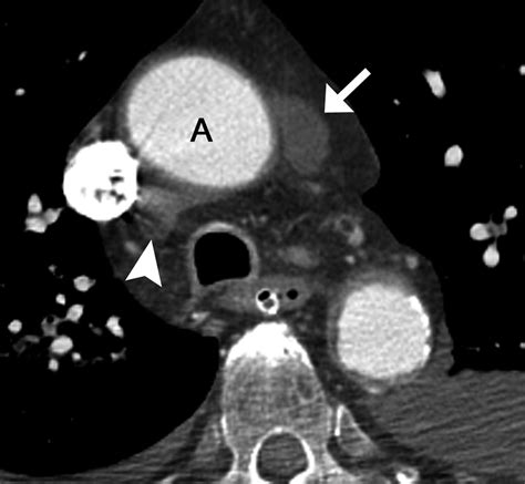 Anatomic Pitfalls Of The Heart And Pericardium Radiographics