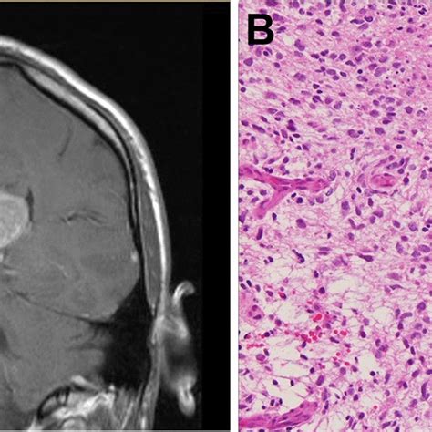 Magnetic Resonance Imaging And Histological Features Of A Download