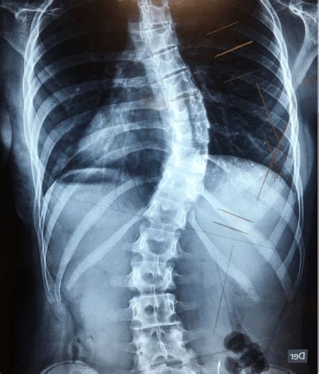 Escoliosis Idiopática Del Adolescente Columna Vertebral Guadalajara