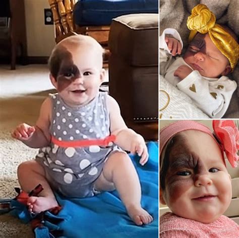 Mom On A Mission To Show Daughter With Extremely Rare Birthmark That