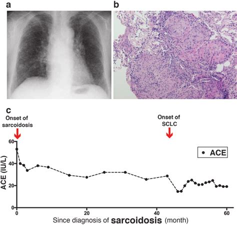 Pulmonary Sarcoidosis At Initial Diagnosis And Its Natural Remission Download Scientific