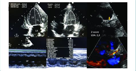 Transthoracic Echocardiogram Of The Boy With Kawasaki Like Showing