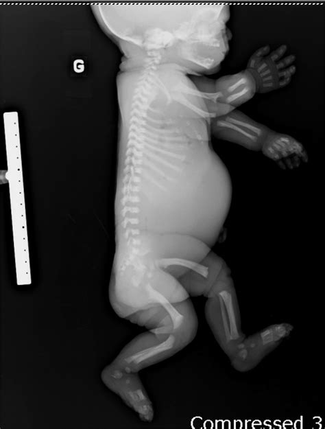 Medical Pictures Info Achondroplasia