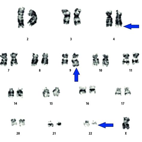 Chromosomal Analysis Revealed The Presence Of Variant Philadelphia