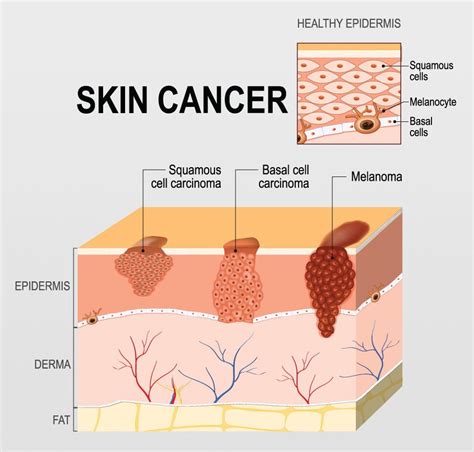 Skin Cancer Body Map