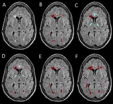 Figure 2 From Simultaneous Lesion And Neuroanatomy Segmentation In Multiple Sclerosis Using Deep