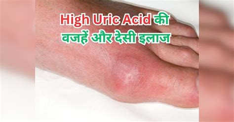 High Uric Acid Causes And Remedies How To Control High Uric Acid High