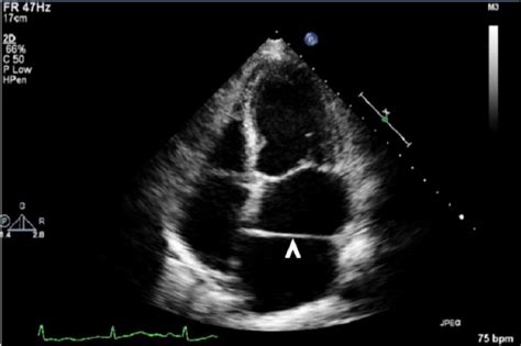 Incidental Finding Of Cor Triatriatum Sinistrum In An Adult Stephanie