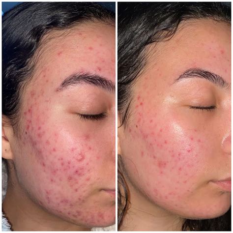 Nearly 3 Months On Tret R Tretinoin