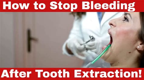 Quick And Easy How To Stop Bleeding After Tooth Extraction YouTube