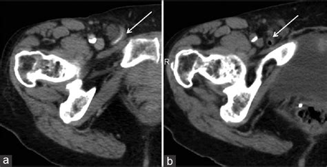 Periappendicular Abscess Presenting Within An Inguinal Hernia Journal Of Clinical Imaging Science