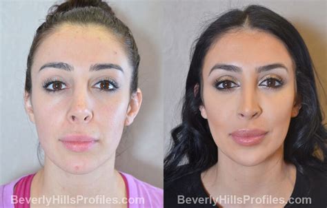 Revision Rhinoplasty Before After Photos