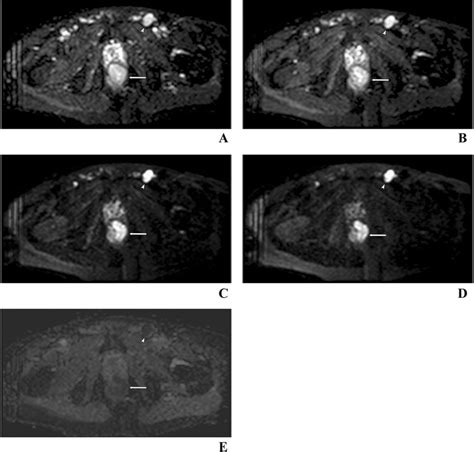 Magnetic Resonance Imaging And Endorectal Ultrasound For Diagnosis Of