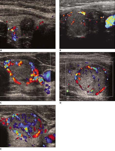 Thyroid Cancer Ultrasound Colors - Thyroid Cancer Happens | Children's ...