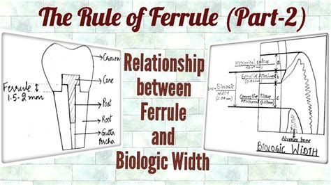 Ferrule Effect Part 2 Relationship Between Ferrule And Biologic