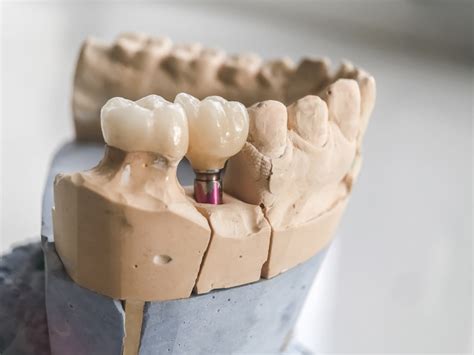 Are There Factors That Determine Which Type Of Dental Implant Procedure