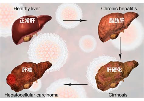 从脂肪肝到肝癌