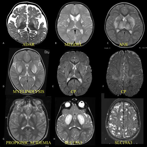 Cluster T W A H And Diffusion I Axial Mri Images From Patients In