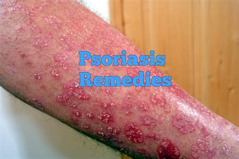 10 Home Remedies for Psoriasis - Home Remedies App