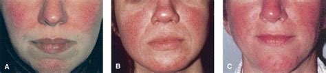 Grading System For Rosacea