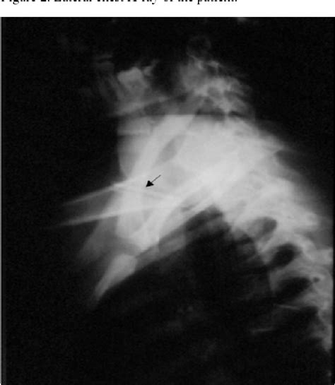 Figure 2 From An Unusual Penetrating Neck Trauma In Zone Iii Semantic Scholar