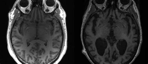 Alzheimer Novo Medicamento Retarda Em A Progress O Da Doen A Top