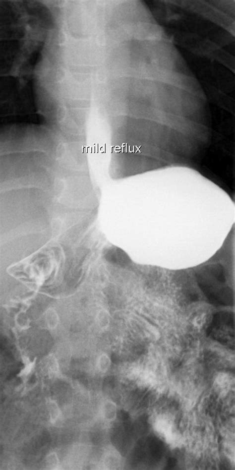 Gastroesophageal Reflux Disease Chest X Ray Wikidoc