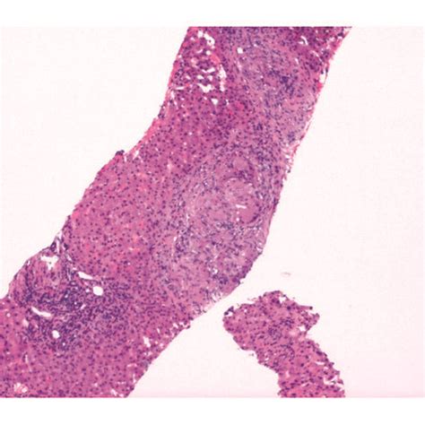 Liver Biopsy A Liver H E X Low Power View Showing Liver