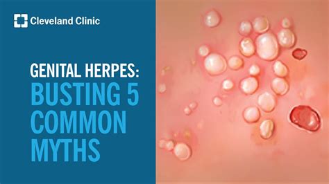 Busting 5 Myths About Genital Herpes YouTube