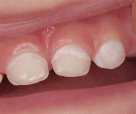 ¿qué Son Las Caries Del Biberón Los Bebés Pueden Tener Caries