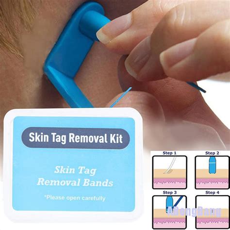 Abongbang Pcs Skin Tag Removal Rubber Bands Micro Band Non Toxic