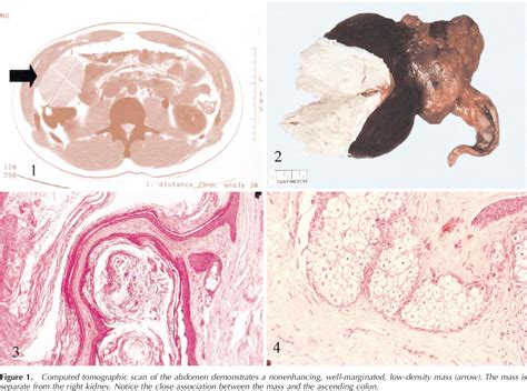 Figure 1 From Dermoid Cyst Mature Cystic Teratoma Of The Cecum