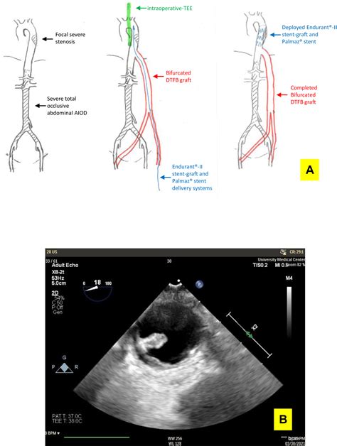 Descending Thoracic Aorta To Bilateral Femoral Artery Bypass And Thoracic Endovascular Aortic