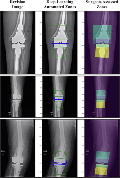 Standardized Fixation Zones And Cone Assessments For Revision Total