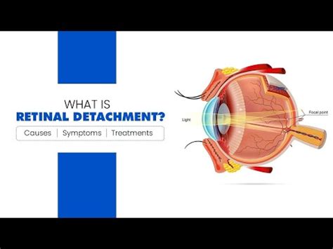 What Is Retinal Detachment Detached Retina Causes Symptoms And