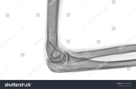 Xray Elbow Radiography Right Elbow Lateral Stock Photo 1449363065