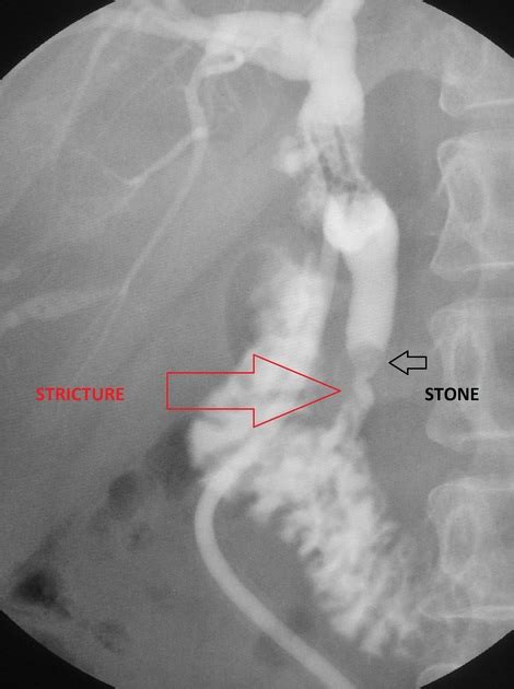 T Tube Cholangiogram