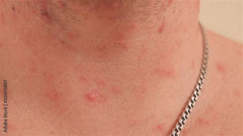 Close Up Of Chicken Pox On The Neck And Chest Of An Adult Male Man Is